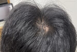 眠れないのは、頭皮にサインが現れる
